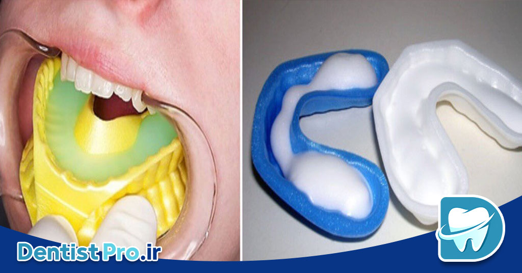 فلورایدتراپی برای کودکان ۳ تا ۶ سال: راهکاری موثر برای پیشگیری از پوسیدگی دندان