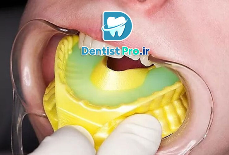 فلورایدتراپی برای کودکان ۳ تا ۶ سال: راهکاری موثر برای پیشگیری از پوسیدگی دندان 27 فلورایدتراپی برای کودکان ۳ تا ۶ سال: راهکاری موثر برای پیشگیری از پوسیدگی دندان