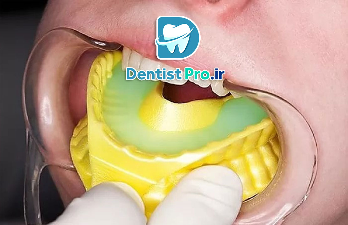 فلورایدتراپی برای کودکان ۳ تا ۶ سال: راهکاری موثر برای پیشگیری از پوسیدگی دندان