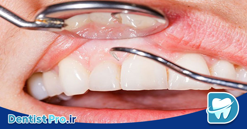 جراحی فلپ لثه: راهکاری تخصصی برای درمان بیماریهای پیشرفته لثه 28 جراحی فلپ لثه: راهکاری تخصصی برای درمان بیماریهای پیشرفته لثه