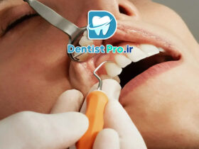 جراحی فلپ لثه: راهکاری تخصصی برای درمان بیماری‌های پیشرفته لثه