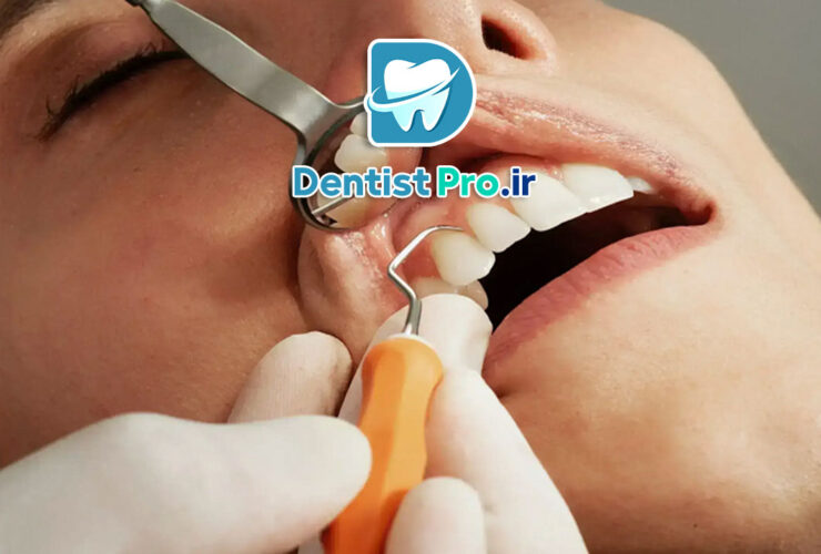 جراحی فلپ لثه: راهکاری تخصصی برای درمان بیماری‌های پیشرفته لثه