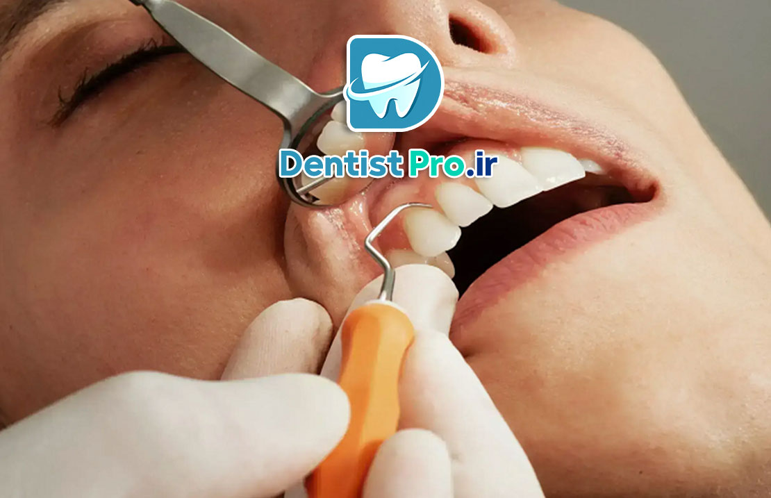 جراحی فلپ لثه: راهکاری تخصصی برای درمان بیماریهای پیشرفته لثه 25 جراحی فلپ لثه: راهکاری تخصصی برای درمان بیماریهای پیشرفته لثه