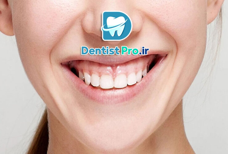 درمان لبخند لثه ای+0 تا 100 موارد مهم