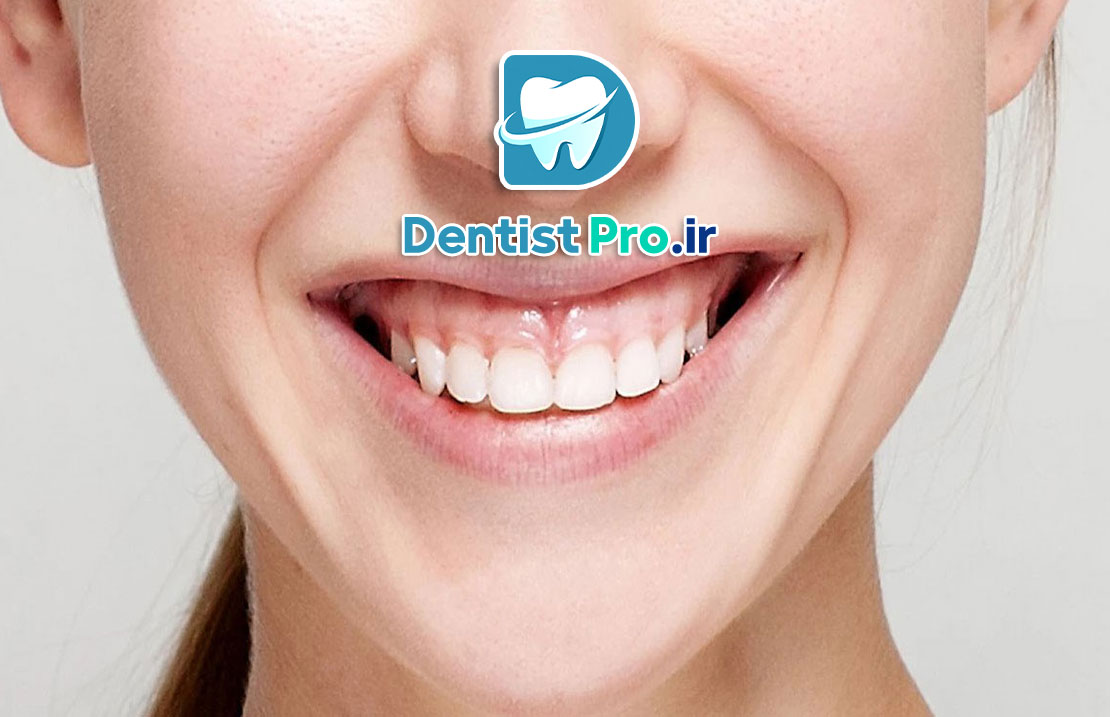 درمان لبخند لثه ای+0 تا 100 موارد مهم 25 درمان لبخند لثه ای+0 تا 100 موارد مهم