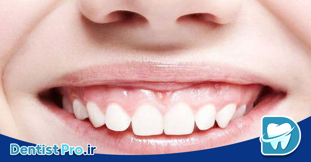 درمان لبخند لثه ای+0 تا 100 موارد مهم 27 درمان لبخند لثه ای+0 تا 100 موارد مهم