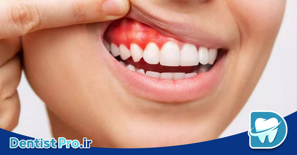 لثه در دوران بارداری: مراقبتها، مشکلات و راهکارهای حفظ سلامت 27 لثه در دوران بارداری: مراقبتها، مشکلات و راهکارهای حفظ سلامت