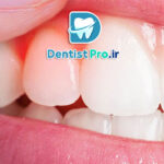 درمان خانگی برای سوزش لثه: راهکارهای طبیعی و مؤثر