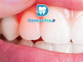 درمان خانگی برای سوزش لثه: راهکارهای طبیعی و مؤثر