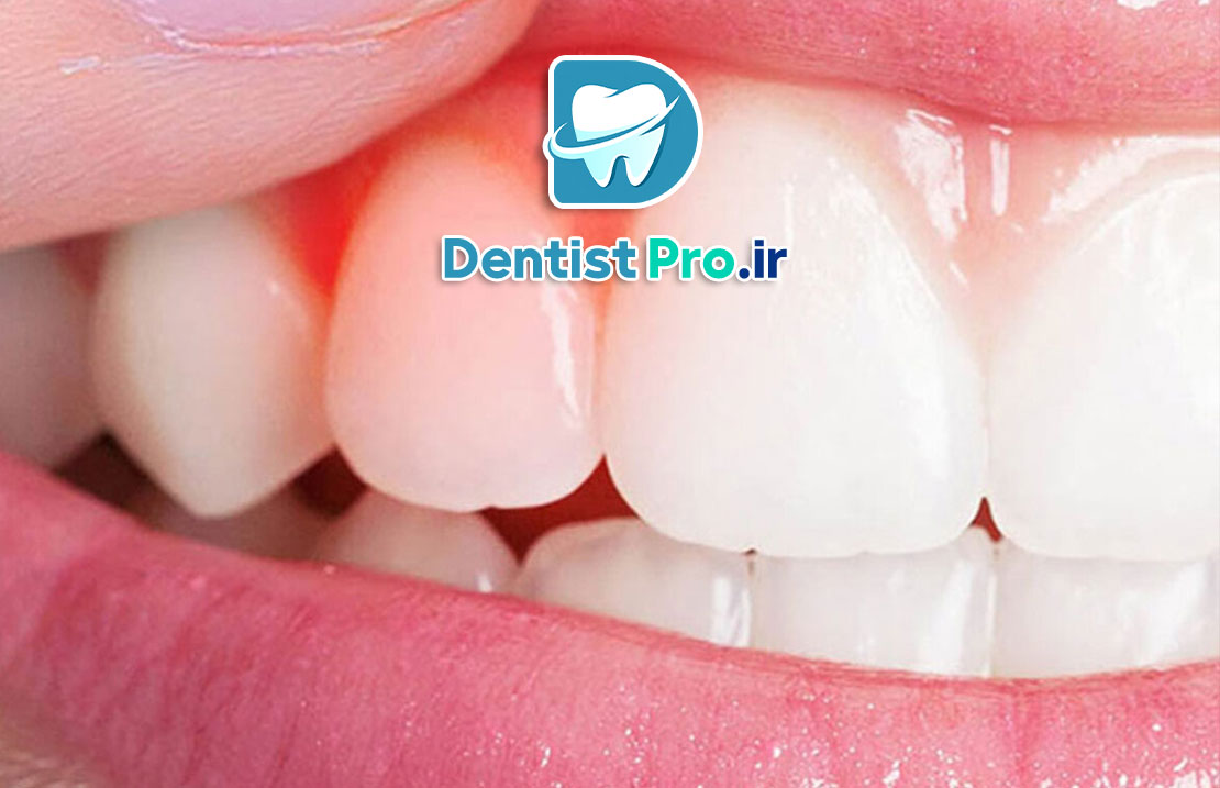 درمان خانگی برای سوزش لثه: راهکارهای طبیعی و مؤثر