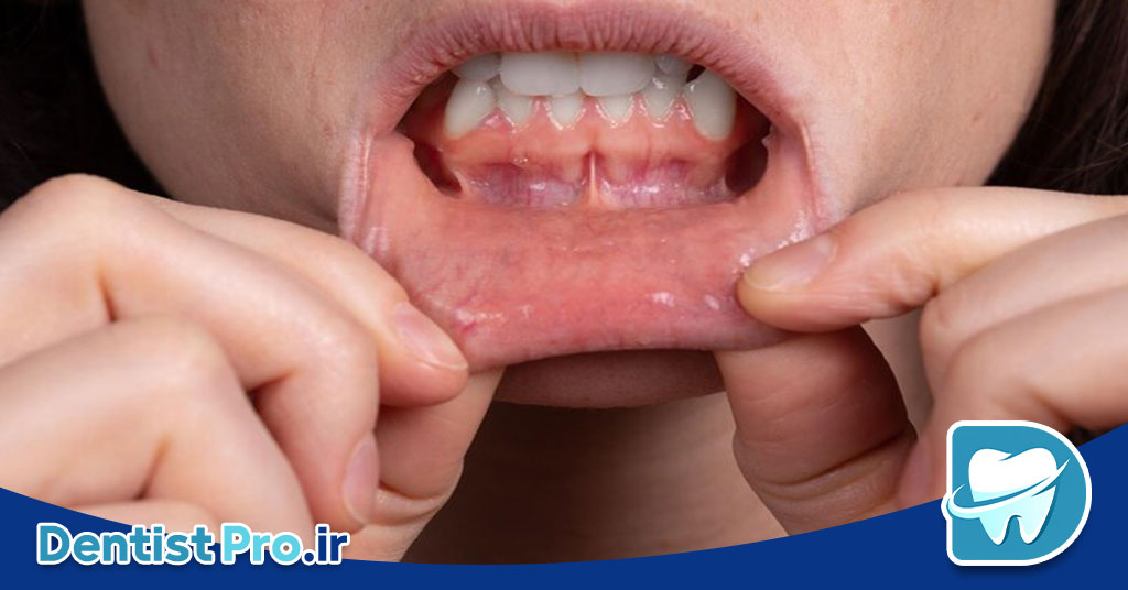 درمان خانگی برای سوزش لثه: راهکارهای طبیعی و مؤثر