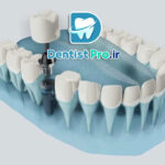 کاشت ایمپلنت فوری با اسکن دیجیتال: انقلابی در دنیای دندان‌پزشکی