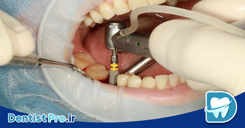 نگهداری از ایمپلنت بعد از کاشت+ موارد 100% حیاتی