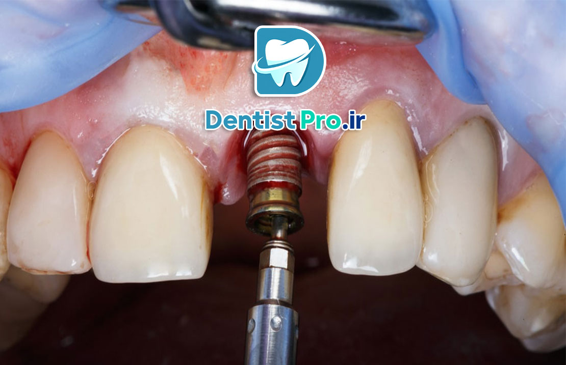 نگهداری از ایمپلنت بعد از کاشت+ موارد 100% حیاتی