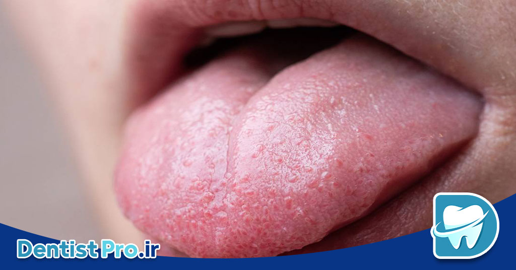التهاب زبان+ بیماری که باید آن را بشناسید 29 التهاب زبان: علل، علائم، تشخیص و روشهای درمان