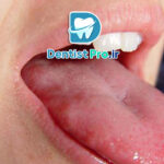 التهاب زبان+ بیماری که باید آن را بشناسید