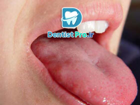 التهاب زبان+ بیماری که باید آن را بشناسید