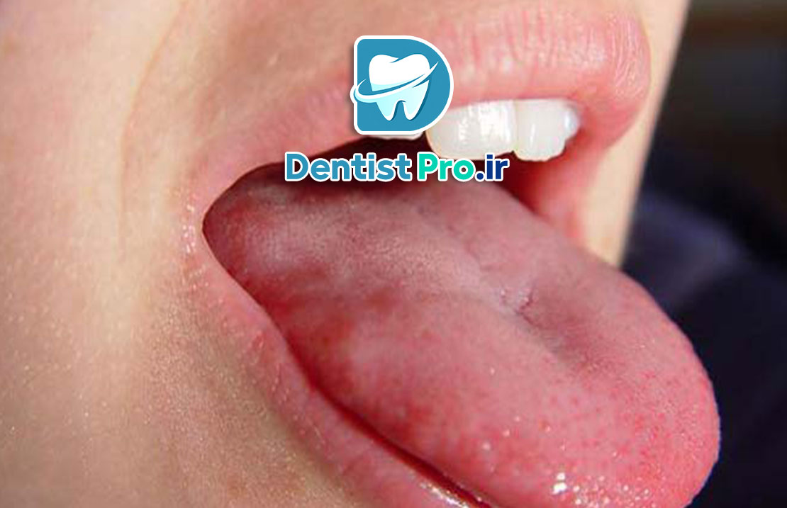 التهاب زبان+ بیماری که باید آن را بشناسید 25 التهاب زبان+ بیماری که باید آن را بشناسید