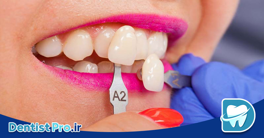 لمینت دندان فوری؛ راهی سریع برای داشتن لبخندی جذاب 28 لمینت دندان فوری؛ راهی سریع برای داشتن لبخندی جذاب