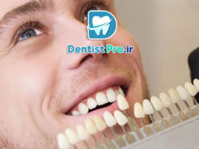 لمینت دندان فوری؛ راهی سریع برای داشتن لبخندی جذاب