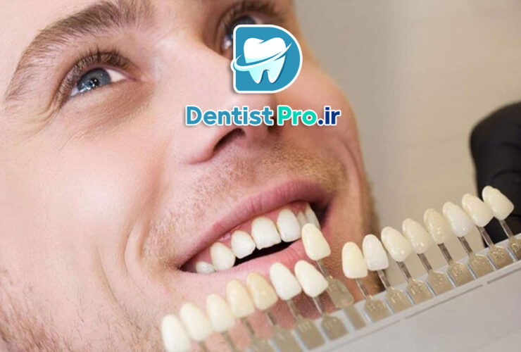لمینت دندان فوری؛ راهی سریع برای داشتن لبخندی جذاب 41 لمینت دندان فوری؛ راهی سریع برای داشتن لبخندی جذاب