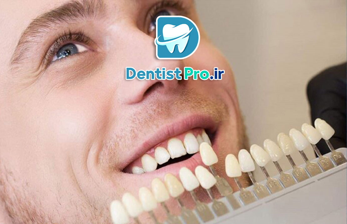 لمینت دندان فوری؛ راهی سریع برای داشتن لبخندی جذاب 25 لمینت دندان فوری؛ راهی سریع برای داشتن لبخندی جذاب