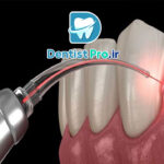 درمان التهاب لثه با لیزر: راهکاری نوین، مؤثر و بدون درد