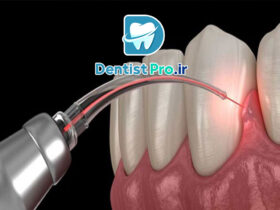 درمان التهاب لثه با لیزر: راهکاری نوین، مؤثر و بدون درد