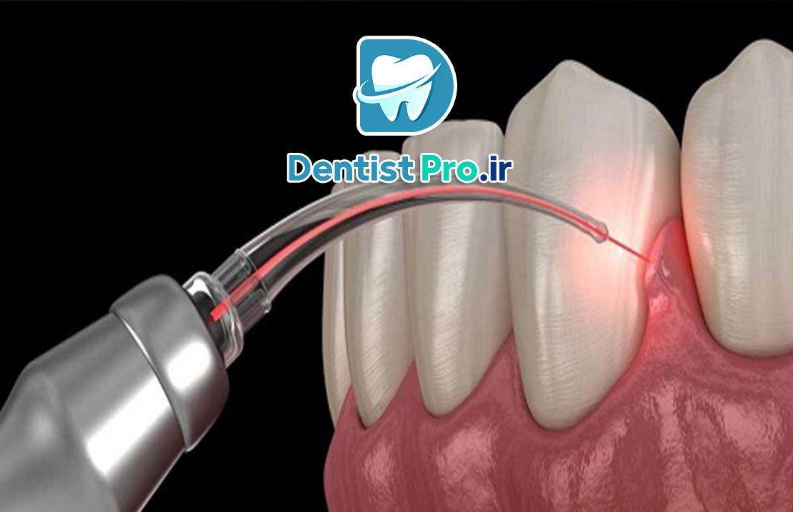درمان التهاب لثه با لیزر: راهکاری نوین، مؤثر و بدون درد