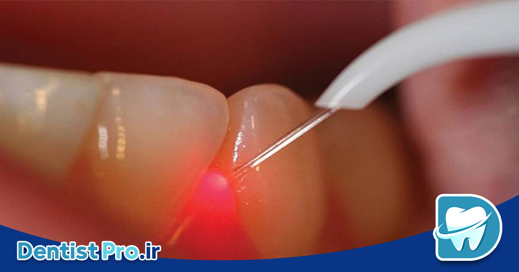 درمان التهاب لثه با لیزر: راهکاری نوین، مؤثر و بدون درد