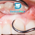 جرم زیر لثه چگونه ایجاد می شود؟