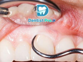 جرم زیر لثه چگونه ایجاد می شود؟