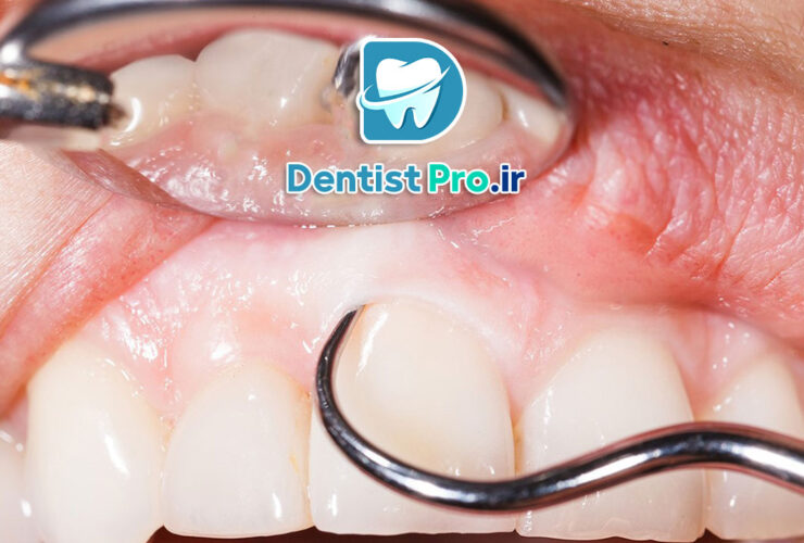 جرم زیر لثه چگونه ایجاد می شود؟