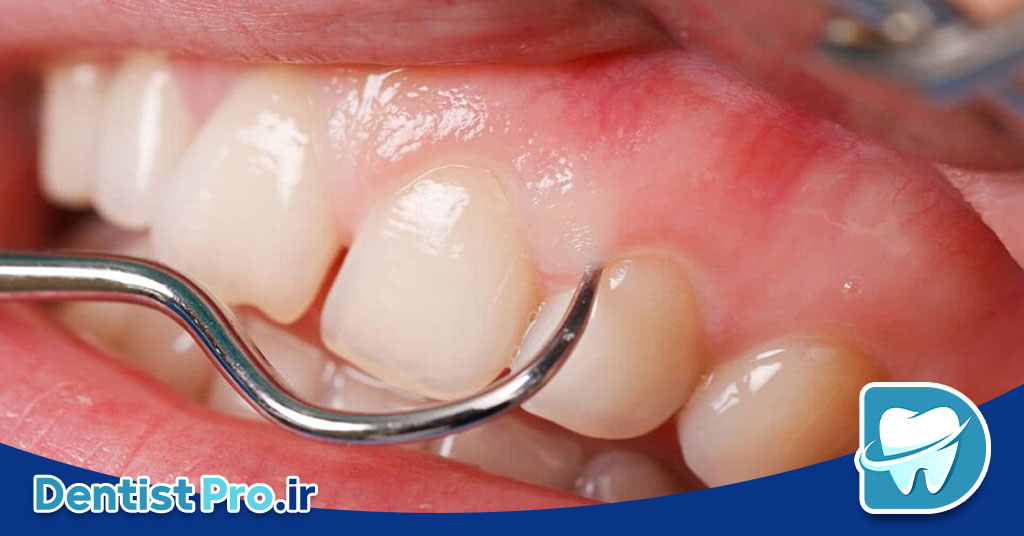 جرم زیر لثه چگونه ایجاد می شود؟