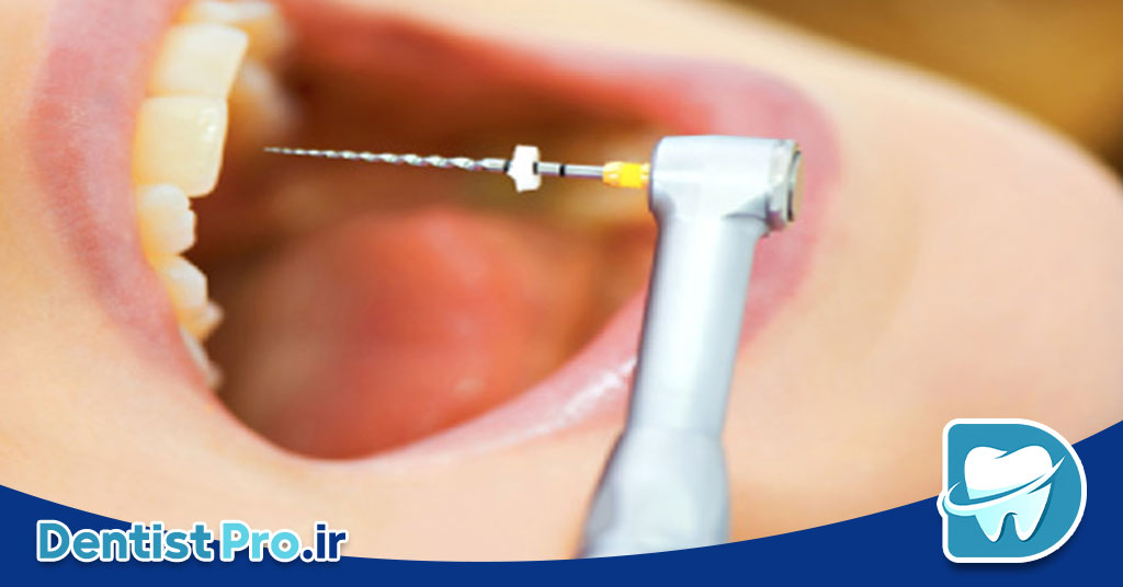 دندان نکروز شده: علل، علائم و درمانهای موثر 29 دندان نکروز شده: علل، علائم و درمانهای موثر