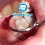 دندان نکروز شده: علل، علائم و درمان‌های موثر