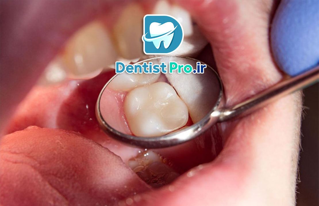 دندان نکروز شده: علل، علائم و درمانهای موثر 25 دندان نکروز شده: علل، علائم و درمانهای موثر