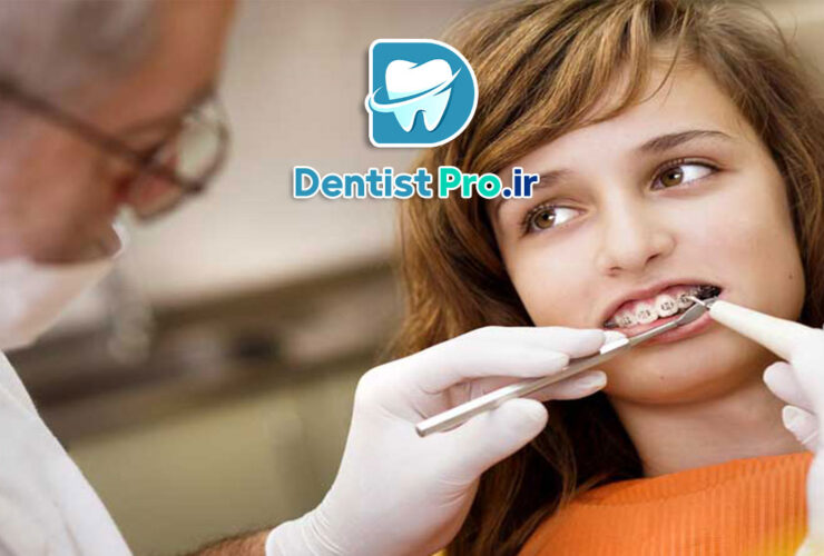 درد ارتودنسی در هفته اول+ موارد بسیار مهم 48 درد ارتودنسی در هفته اول+ موارد بسیار مهم