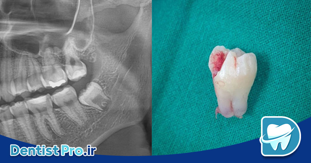 دندان عقل نیمه بیرون زده؛ علل، مشکلات، روشهای درمان و نکات مهم 27 دندان عقل نیمه بیرون زده؛ علل، مشکلات، روشهای درمان و نکات مهم