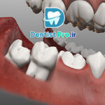 دندان عقل نیمه بیرون زده؛ علل، مشکلات، روش‌های درمان و نکات مهم