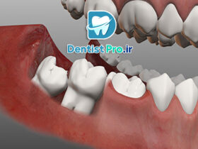 دندان عقل نیمه بیرون زده؛ علل، مشکلات، روش‌های درمان و نکات مهم