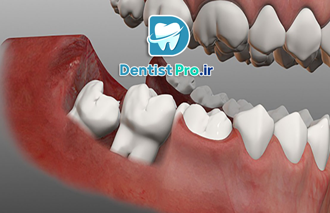 دندان عقل نیمه بیرون زده؛ علل، مشکلات، روشهای درمان و نکات مهم 25 دندان عقل نیمه بیرون زده؛ علل، مشکلات، روشهای درمان و نکات مهم