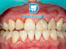 کیسه پریودنتال: شناخت، علل، علائم و درمان