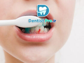10 دلیل به عنوان دلایل خونریزی لثه هنگام مسواک زدن