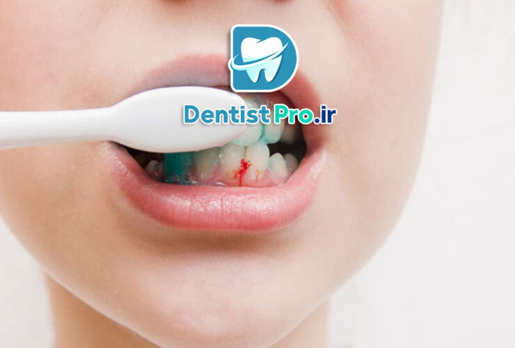 10 دلیل به عنوان دلایل خونریزی لثه هنگام مسواک زدن