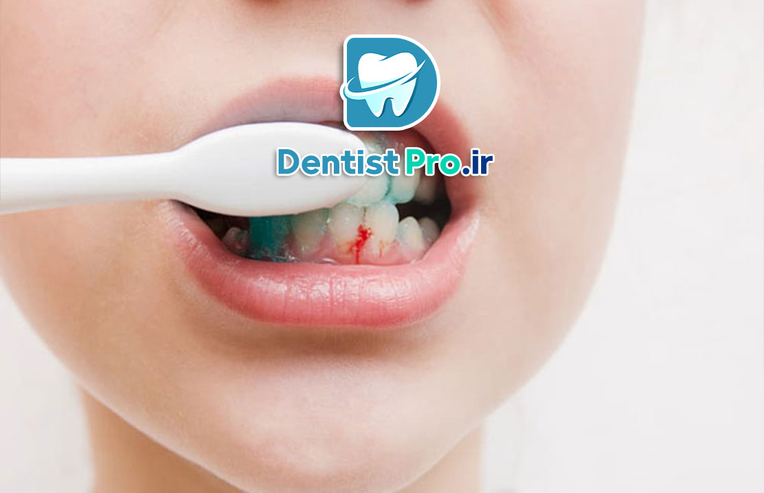 10 دلیل به عنوان دلایل خونریزی لثه هنگام مسواک زدن