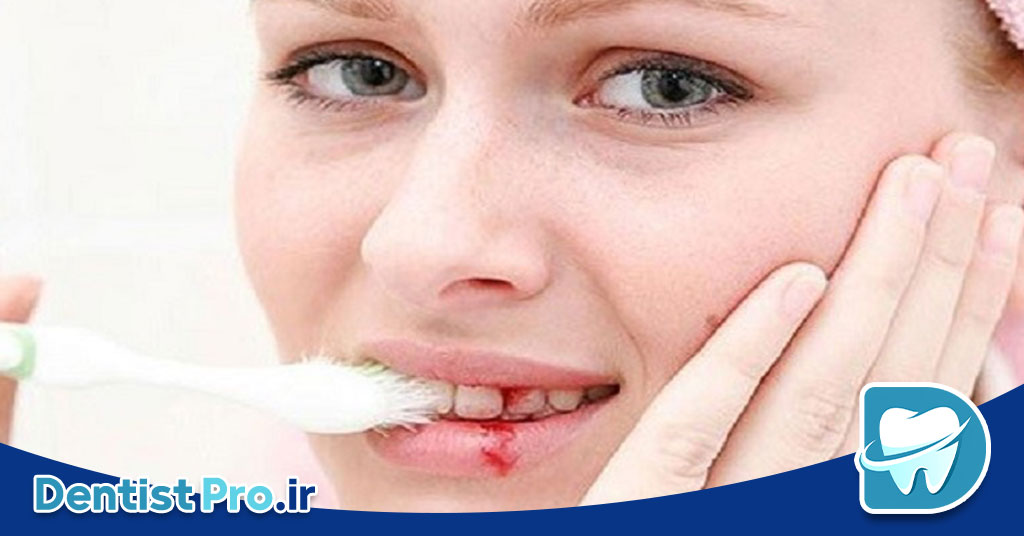 10 دلیل به عنوان دلایل خونریزی لثه هنگام مسواک زدن