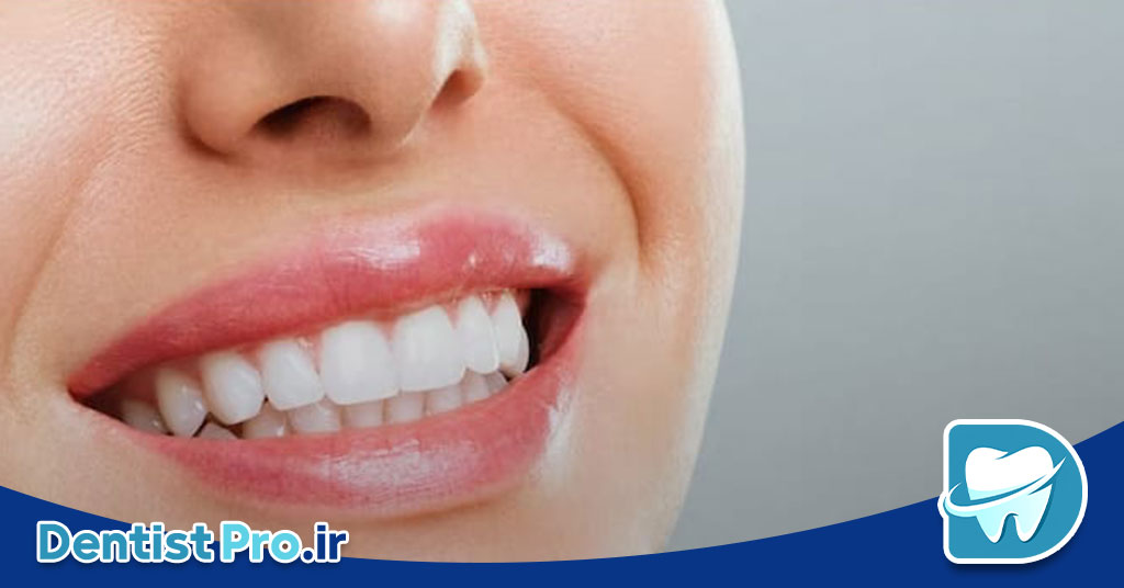 سفید کردن دندان در خانه یا مطب 29 سفید کردن دندان در خانه یا مطب