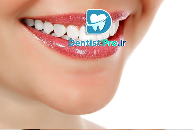 سفید کردن دندان در خانه یا مطب