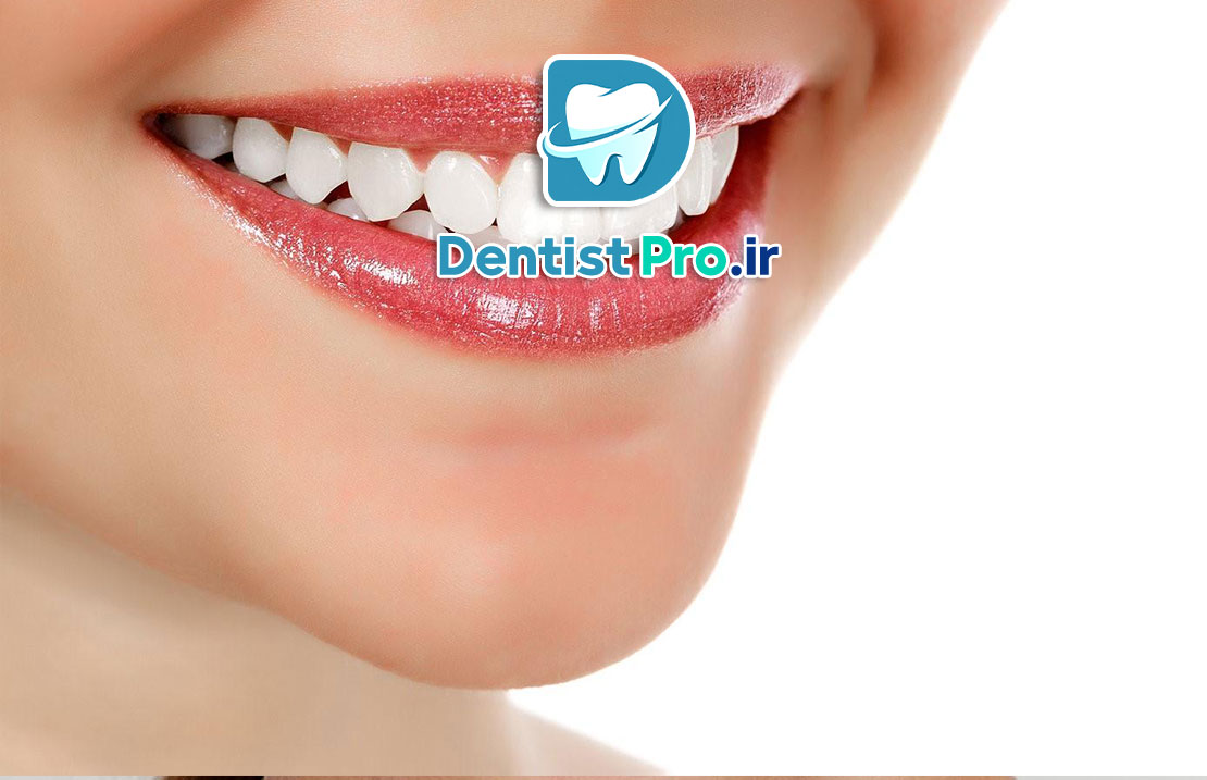 سفید کردن دندان در خانه یا مطب 25 سفید کردن دندان در خانه یا مطب